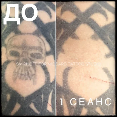 Студия по удалению татуировок new Skin фото 7
