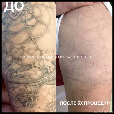 Студия по удалению татуировок new Skin фото 6