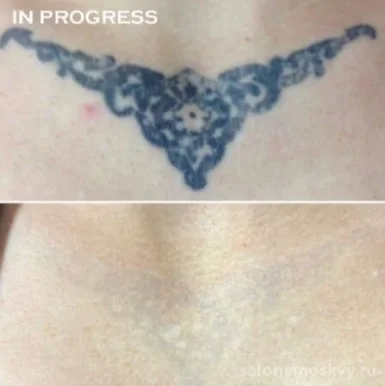 Студия по удалению татуировок и перманентного макияжа NEW SKIN фото 2